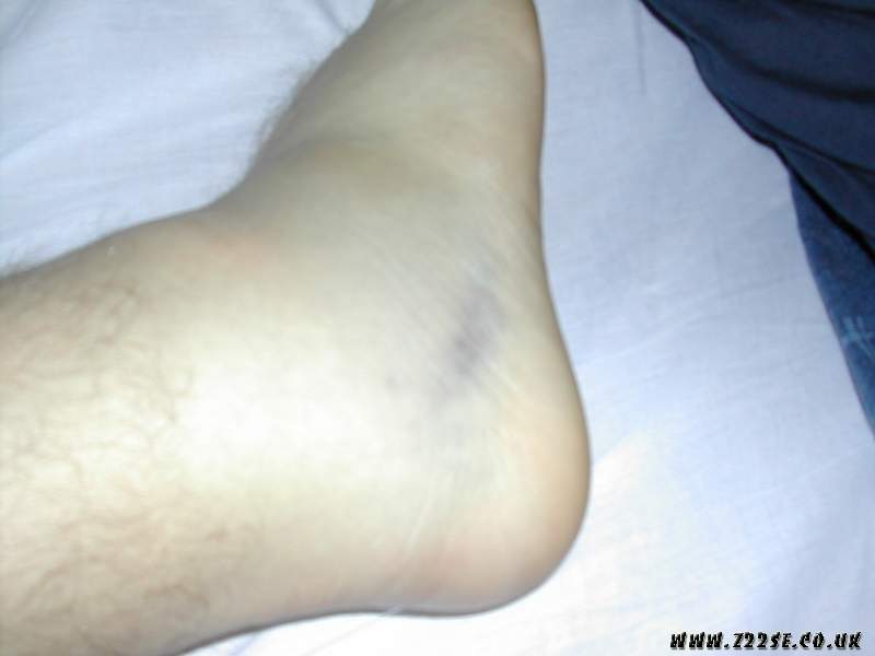acdn.z22se.com_userpix_2_Fat_Ankle_01_1.jpg