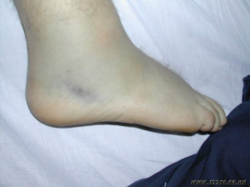 acdn.z22se.com_userpix_2_Fat_Ankle_02_1.jpg