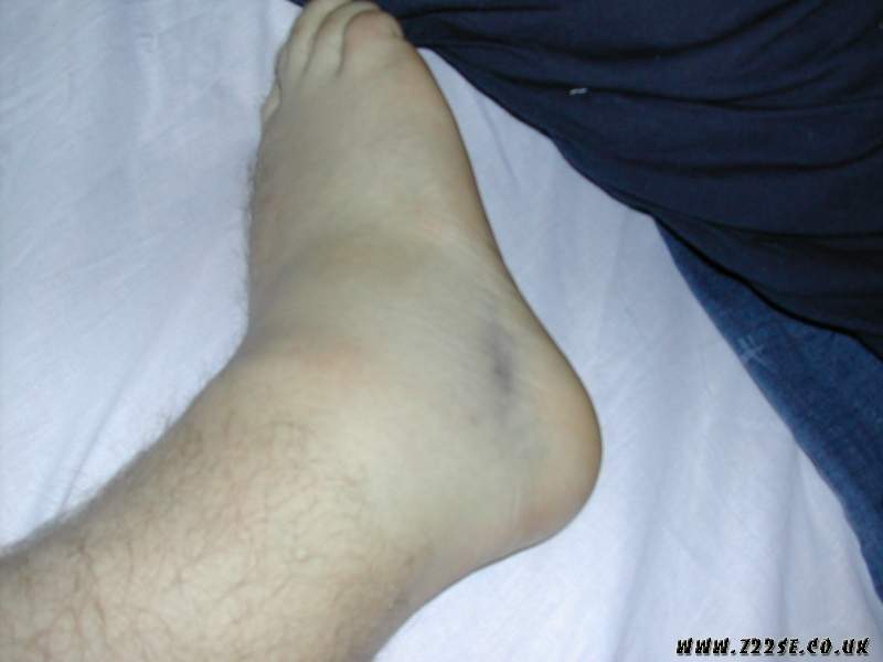 acdn.z22se.com_userpix_2_Fat_Ankle_03_1.jpg